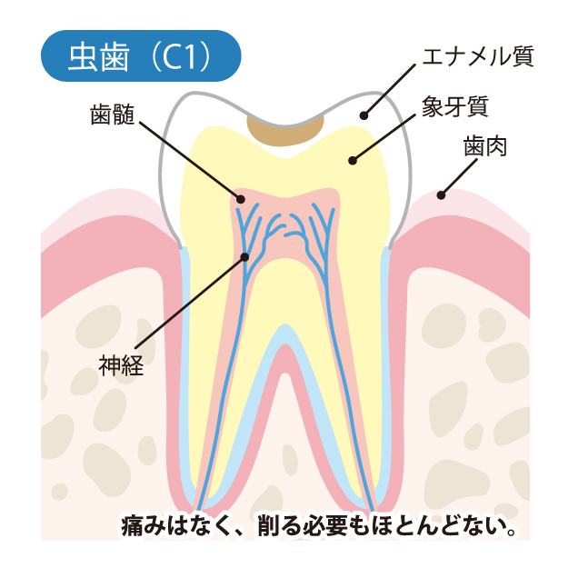 二子玉川の歯医者、大熊歯科医院で虫歯治療