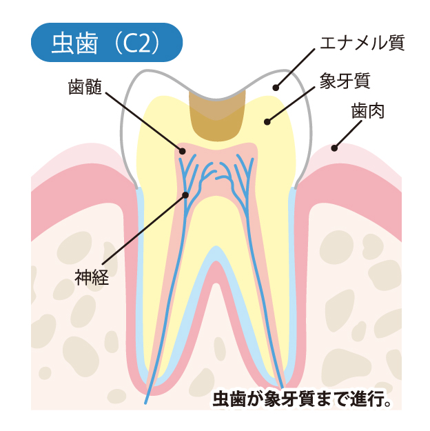 二子玉川の歯医者、大熊歯科医院で虫歯治療