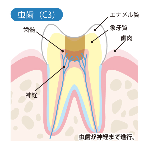 二子玉川の歯医者、大熊歯科医院で虫歯治療