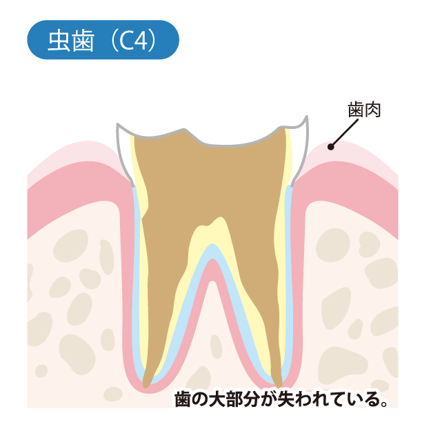 二子玉川の歯医者、大熊歯科医院で虫歯治療