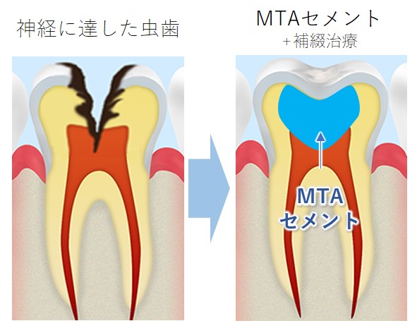 二子玉川の歯医者、大熊歯科医院のMTAセメント